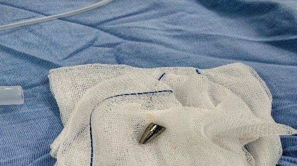 Dị vật là đầu ngòi bút, bề dày thành khoảng 1,8mm, chiều dài khoảng 18mm. (Nguồn: Bệnh viện Phụ sản-Nhi Đà Nẵng)