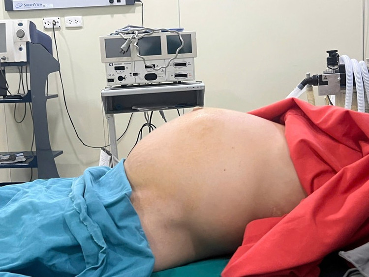 Người phụ nữ mang khối u xơ tử cung nặng gần 10 kg, phát triển suốt 10 năm, khiến bụng bệnh nhân phình to như mang thai đủ tháng. Ảnh BV