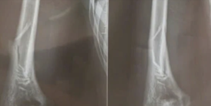 Hình ảnh chụp X-quang nam thanh niên 18 tuổi gãy tay khi chơi vật tay. Ảnh: Bệnh viện cung cấp