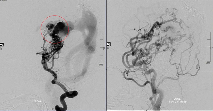 Hình ảnh mạch máu não của bệnh nhân trước và sau khi được các bác sĩ can thiệp. Ảnh tienphong.vn