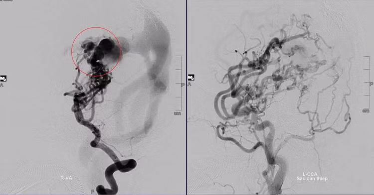 Hình ảnh mạch máu não của bệnh nhân trước và sau khi được các bác sĩ can thiệp. Ảnh tienphong.vn