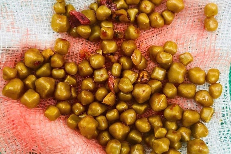 Hơn 100 viên sỏi màu vàng đồng được lấy ra từ túi mật của bệnh nhân D.T.N.T. (Ảnh: Bệnh viện cung cấp).