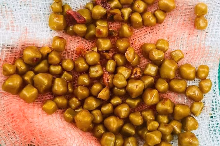 Hơn 100 viên sỏi màu vàng đồng được lấy ra từ túi mật của bệnh nhân D.T.N.T. (Ảnh: Bệnh viện cung cấp).