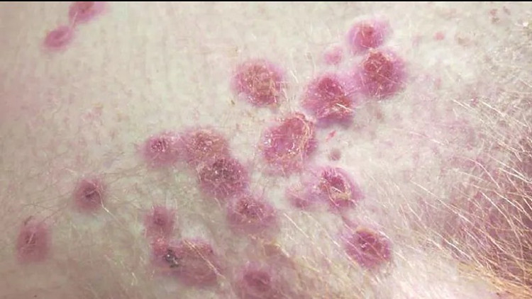 Tổn thương da do bệnh đậu mùa khỉ gây ra. Ảnh Tạp chí Khoa học Thú y