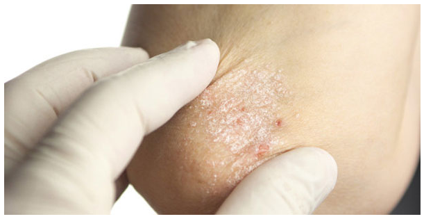 Chăm sóc da đúng cách mùa đông để giảm vảy nến ảnh 1