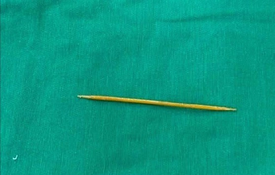 Dị vật là tăm tre trong bụng bệnh nhân/ Ảnh SKĐS