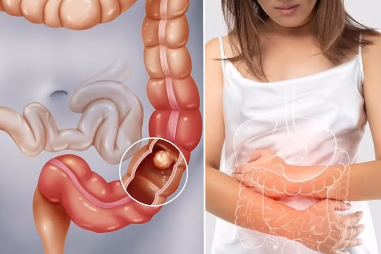 Khi một khối bã thức ăn hình thành trong dạ dày, xuống ruột non sẽ gây tắc nghẽn. Ảnh minh họa/Internet