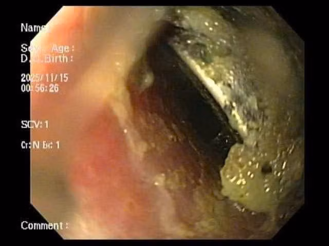Hình ảnh viên pin cúc trong thực quản bệnh nhi. Ảnh: Bệnh viện Nhi Hải Phòng