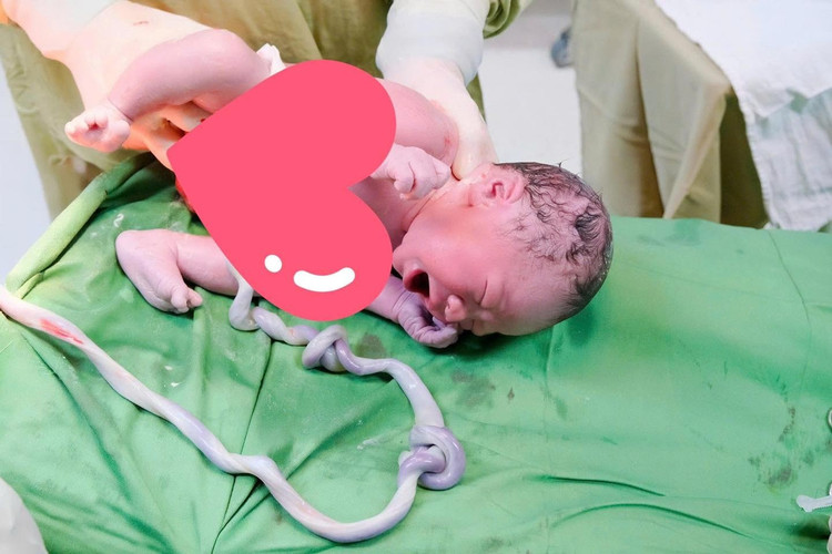 Bé trai chào đời khỏe mạnh dù dây rốn thắt hai nút. Ảnh BV