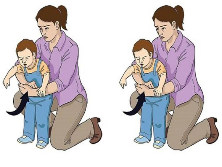 Thủ thuật Heimlich. Ảnh minh họa/Internet