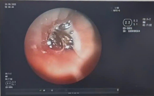 Hình ảnh cho thấy hạt hồng xiêm nằm sâu trong lòng phế quản. Ảnh BV