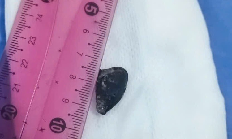 Hạt hồng xiêm được lấy ra sau 10 năm nằm trong phế quản. Ảnh BV