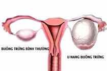 Sự thật cần biết về u nang buồng trứng, mọi phụ nữ cần biết