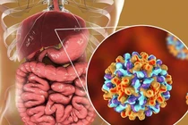 Triệu chứng ung thư gan giai đoạn đầu ít người biết