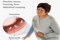 Triệu chứng nhiễm khuẩn Salmonella dễ nhầm lẫn