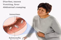 Triệu chứng nhiễm khuẩn Salmonella dễ nhầm lẫn