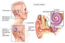 Loạt biến chứng nguy hiểm khi cấy ốc tai điện tử