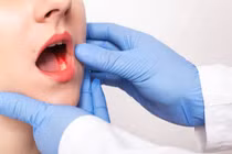 Dấu hiệu cảnh báo sớm ung thư lưỡi nhiều người bỏ qua