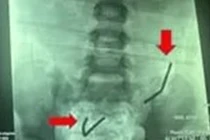 Bác sĩ phát hiện 20 viên nam châm đã rỉ sét trong ruột bệnh nhi