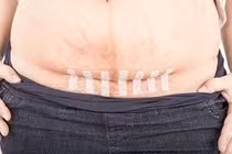 Kịp thời cứu sống hai mẹ con sản phụ thai 39 tuần nguy kịch do vỡ tử cung