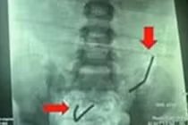 Bác sĩ phát hiện 20 viên nam châm đã rỉ sét trong ruột bệnh nhi