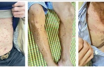 Nguy cơ dị ứng thuốc gây hội chứng Stevens-Johnson đe dọa thị lực