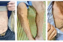 Nguy cơ dị ứng thuốc gây hội chứng Stevens-Johnson đe dọa thị lực