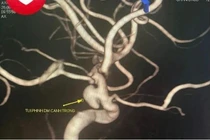 Cứu bệnh nhân 33 tuổi ở Quảng Ninh thoát khỏi nguy cơ đột quỵ