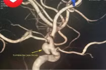 Cứu bệnh nhân 33 tuổi ở Quảng Ninh thoát khỏi nguy cơ đột quỵ