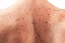 Dấu hiệu cảnh báo sớm ung thư da