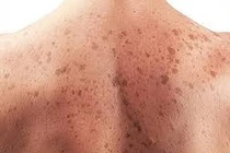 Dấu hiệu cảnh báo sớm ung thư da