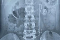 Phẫu thuật thành công cho bệnh nhân quên thiết bị y tế trong người