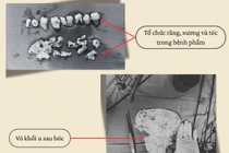 Phát hiện u quái buồng trứng chứa răng, xương, tóc hiếm gặp