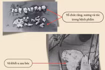 Phát hiện u quái buồng trứng chứa răng, xương, tóc hiếm gặp