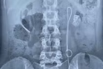 Phẫu thuật thành công cho bệnh nhân quên thiết bị y tế trong người