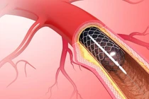 Nhiều ca nhồi máu cơ tim nguy kịch được cứu sống nhờ can thiệp kịp thời