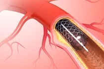 Nhiều ca nhồi máu cơ tim nguy kịch được cứu sống nhờ can thiệp kịp thời