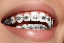 Soi giá dịch vụ Nha khoa Thẩm mỹ Anh Dental 