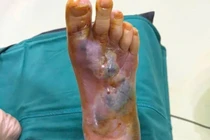 Từ vết xước nhỏ, cụ bà ở Hà Nội suýt mất bàn chân do nhiễm trùng kháng thuốc