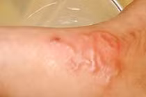 Gần 6.400 người mắc bệnh giun sán trong 3 tháng ở Khánh Hòa