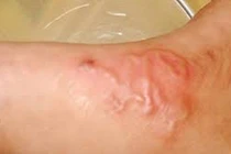 Gần 6.400 người mắc bệnh giun sán trong 3 tháng ở Khánh Hòa