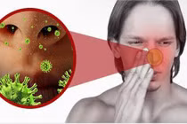 Người phụ nữ bị nấm xoang bướm hiếm gặp