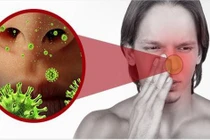 Người phụ nữ bị nấm xoang bướm hiếm gặp