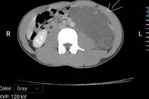 Bệnh nhân 25 tuổi mắc u Lymphangioma sau phúc mạc - bệnh lý hiếm gặp