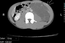Bệnh nhân 25 tuổi mắc u Lymphangioma sau phúc mạc - bệnh lý hiếm gặp