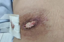 Người phụ nữ Quảng Trị bị hoại tử lưng do tự ý đắp lá trị mụn