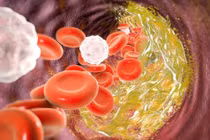 Dấu hiệu cảnh báo mỡ máu cao vào buổi sáng