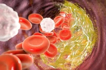 Dấu hiệu cảnh báo mỡ máu cao vào buổi sáng