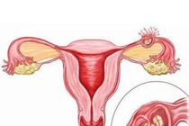 Phẫu thuật cứu sản phụ bị chửa ngoài tử cung vỡ đe dọa tính mạng