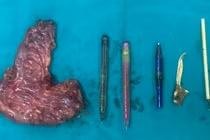 Mắc hội chứng Pica khiến người bệnh tự 'nuốt đủ thứ' vào bụng